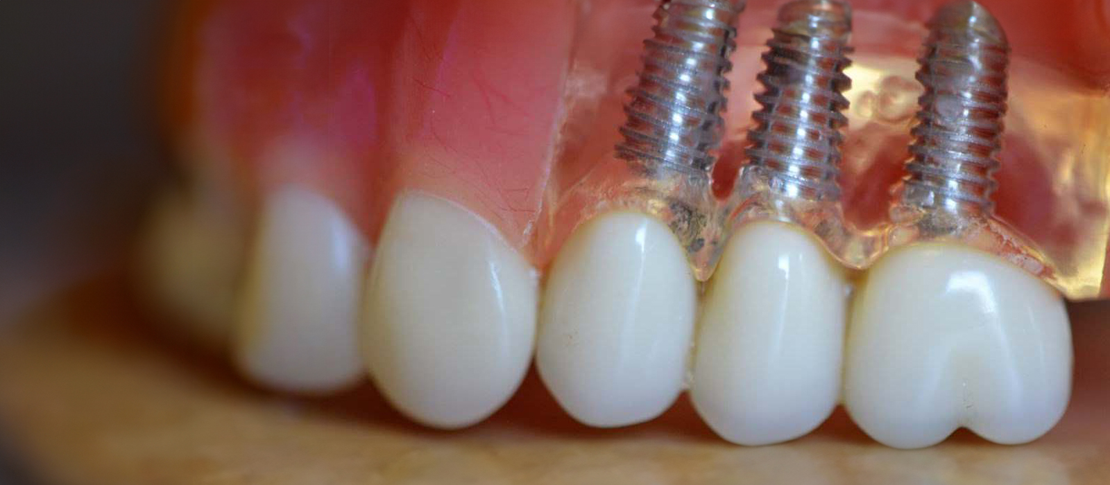 The image shows a close-up of a dental implant with screws and a tooth, displayed against a blurred background.